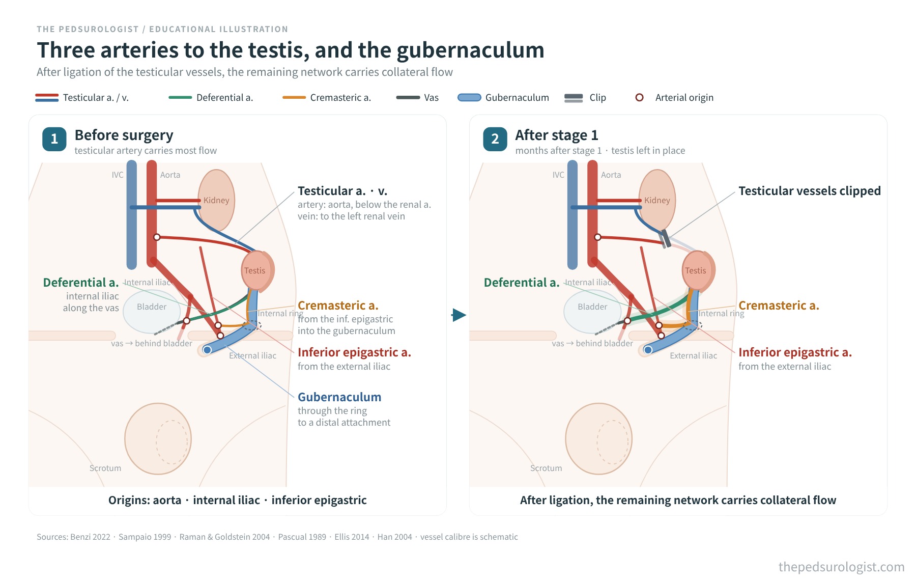 Schematic comparing the three arteries of the intra-abdominal testis with their origins and the gubernacular attachment, and the situation after first-stage ligation of the testicular vessels, when the deferential and cremasteric vessels carry collateral flow