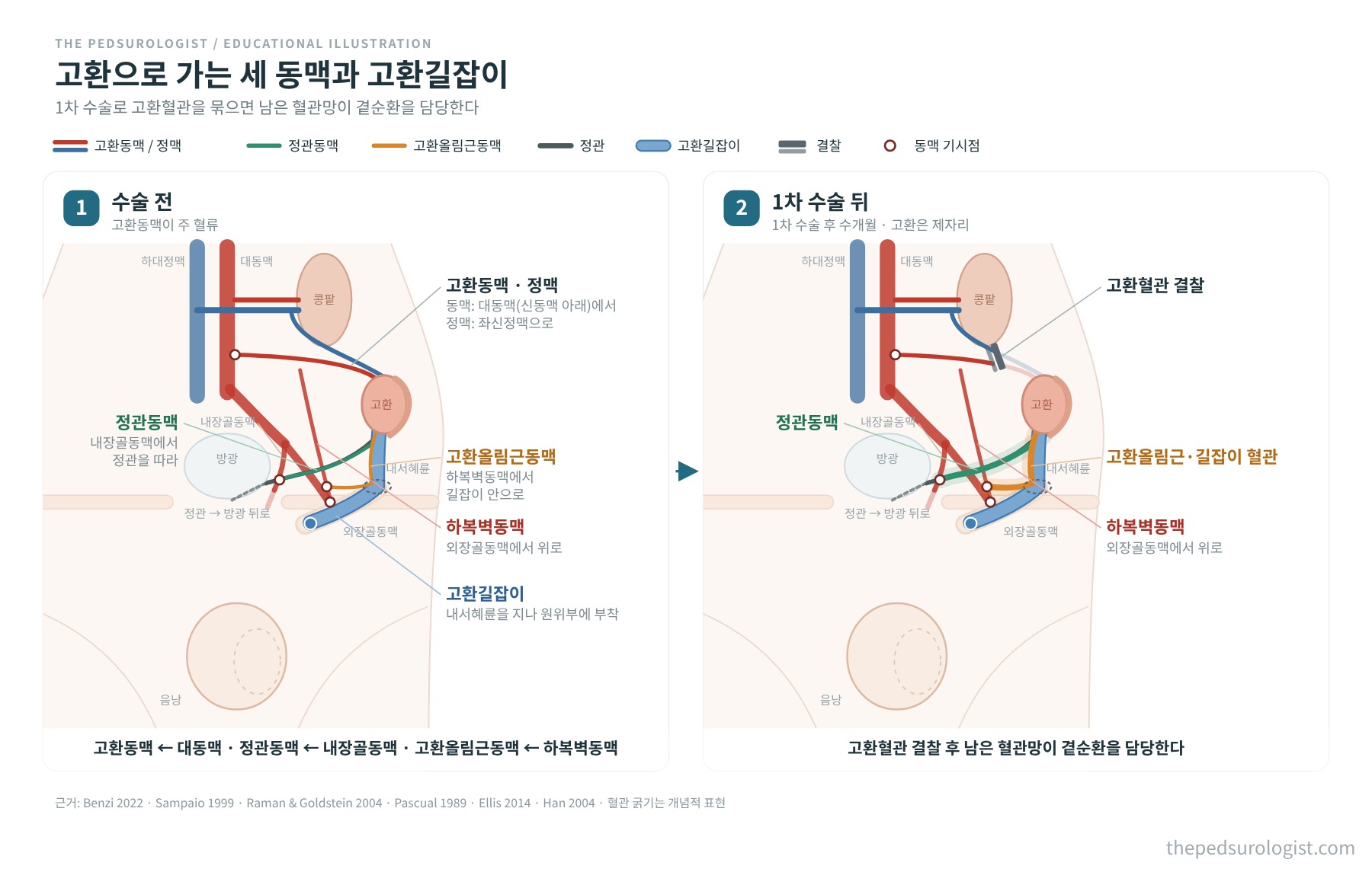 복강 내 고환의 세 동맥과 각 동맥의 기시점, 고환길잡이 부착, 그리고 1차 수술로 고환혈관을 결찰한 뒤 정관동맥과 고환올림근 혈관이 곁순환을 맡는 모습을 비교한 도식