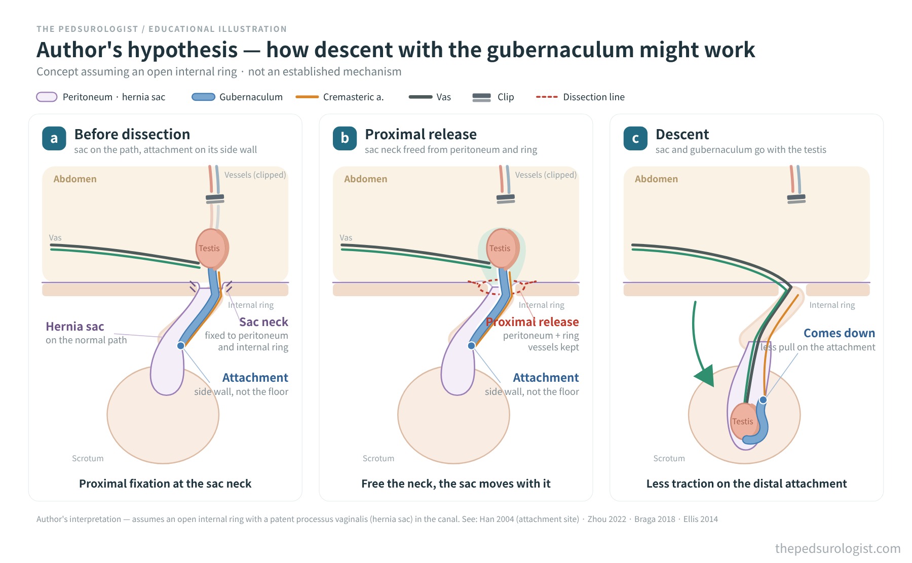 Concept drawing of the author's hypothesis: the hernia sac lies on the normal path with the gubernaculum attached to its side wall; freeing the sac neck from the peritoneum and internal ring lets the sac and attachment move with the testis, reducing traction on the distal attachment