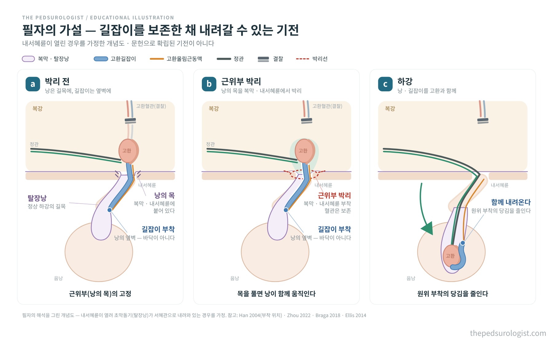 필자의 해석을 그린 개념도. 탈장낭은 정상 하강 길목에 있고 고환길잡이는 낭의 옆벽에 붙어 있으며, 낭의 목을 복막과 내서혜륜에서 박리하면 낭과 길잡이 부착이 고환과 함께 움직여 원위부 부착에 걸리는 당김이 줄어든다는 그림