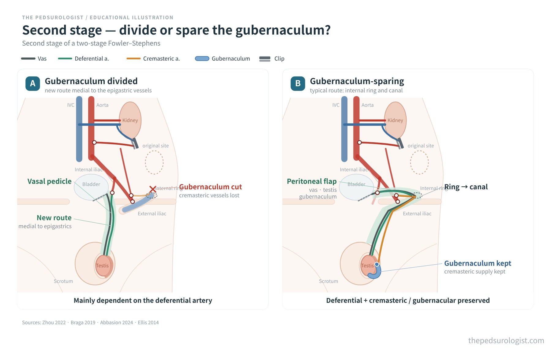 Schematic comparing, at the second stage of a two-stage Fowler–Stephens procedure, division of the gubernaculum with passage through a new route medial to the inferior epigastric vessels, and preservation of the gubernaculum with delivery through the internal ring and canal