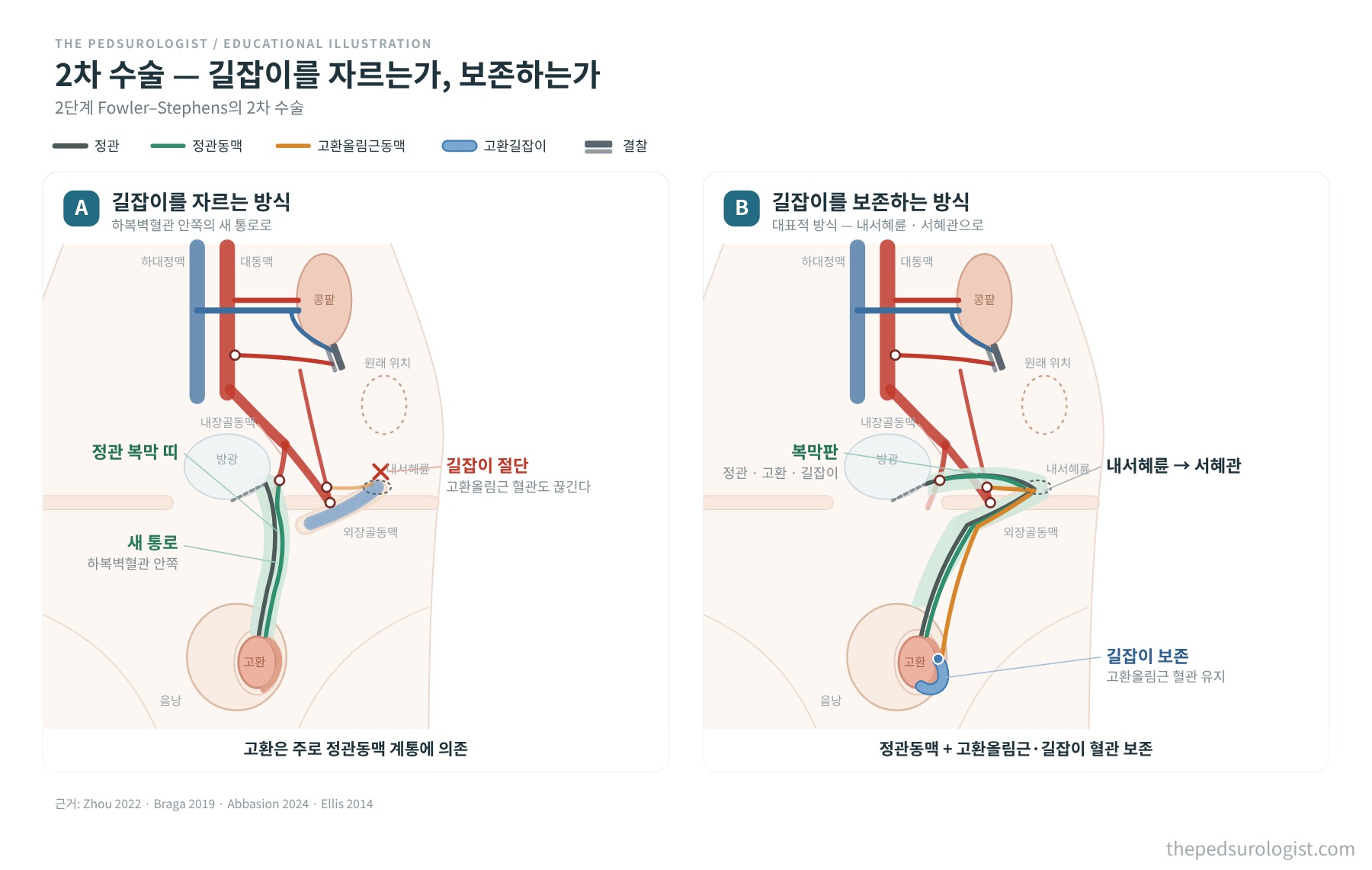 2단계 Fowler-Stephens 2차 수술에서 고환길잡이를 잘라 하복벽혈관 안쪽 새 통로로 내리는 방식과, 길잡이를 보존해 내서혜륜과 서혜관으로 내리는 방식을 비교한 도식