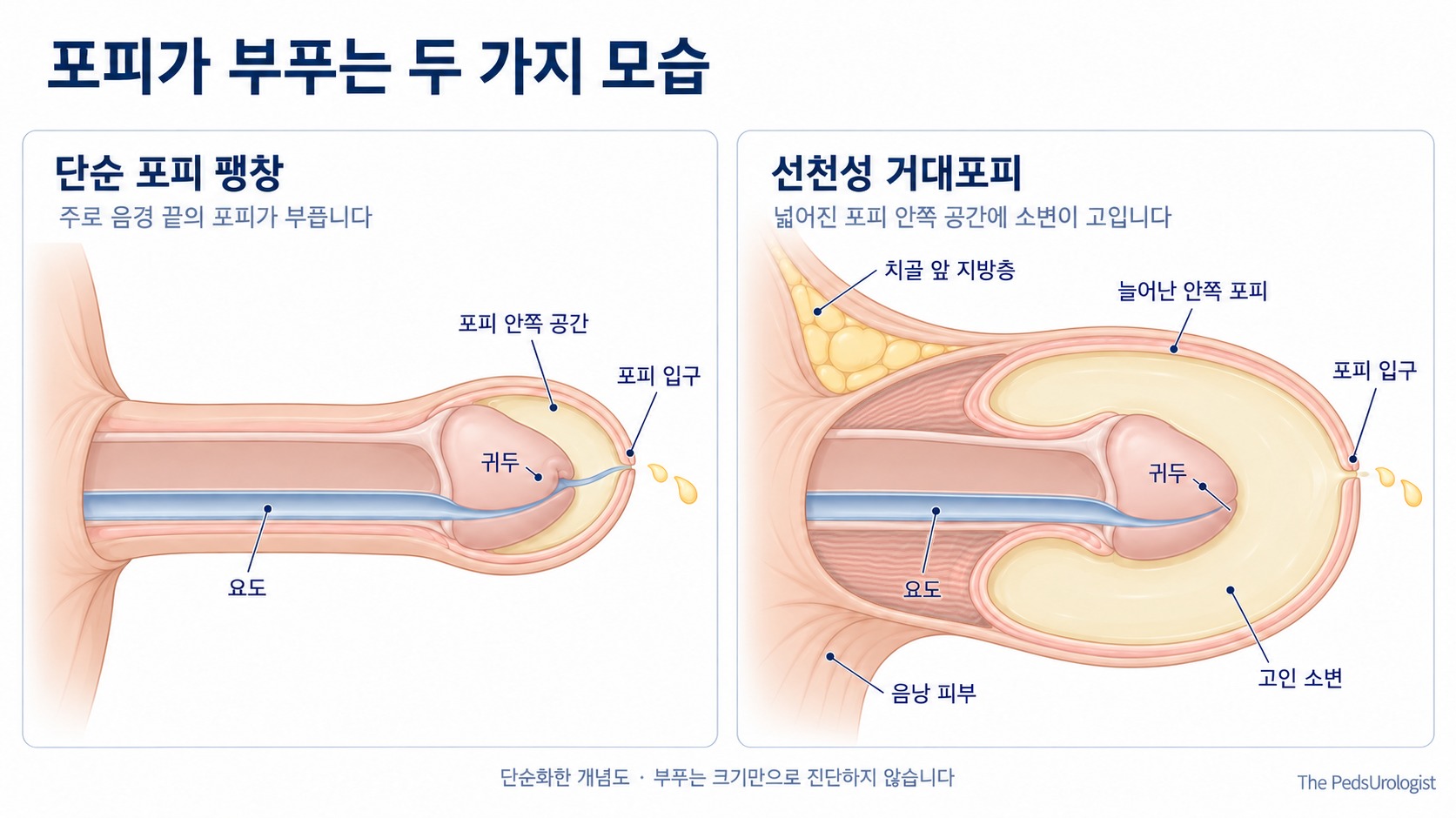 단순 포피 팽창과 선천성 거대포피의 옆단면 비교. 요도와 포피 안쪽 소변 공간을 구분하며, 오른쪽 피부가 위로 치골 앞 지방층, 아래로 음낭 피부와 이어지는 관계를 나타낸 개념도.