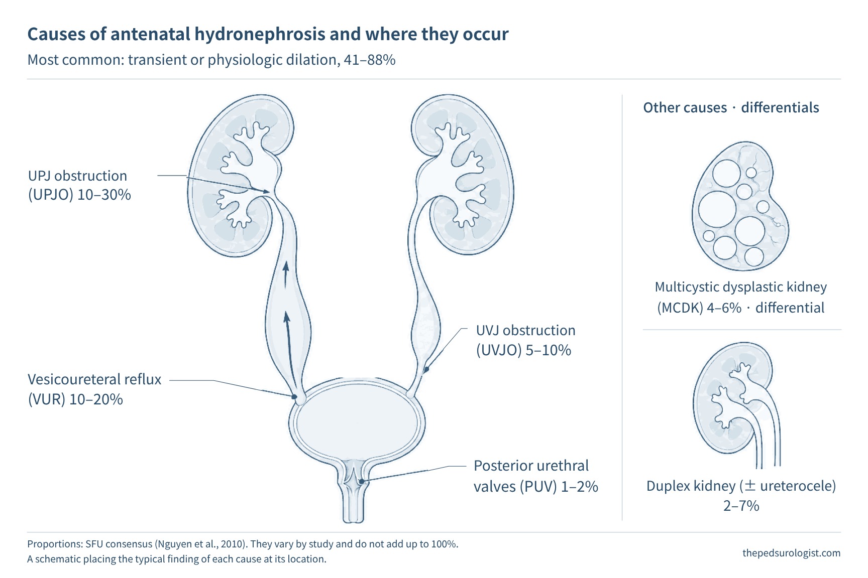 Diagram of the urinary tract showing both kidneys, ureters, bladder and urethra, with the causes of antenatal hydronephrosis marked by location. Ureteropelvic junction obstruction 10–30%, vesicoureteral reflux 10–20%, ureterovesical junction obstruction 5–10%, posterior urethral valves 1–2%, multicystic dysplastic kidney 4–6%, duplex kidney (± ureterocele) 2–7%. The most common, transient or physiological dilation, 41–88%