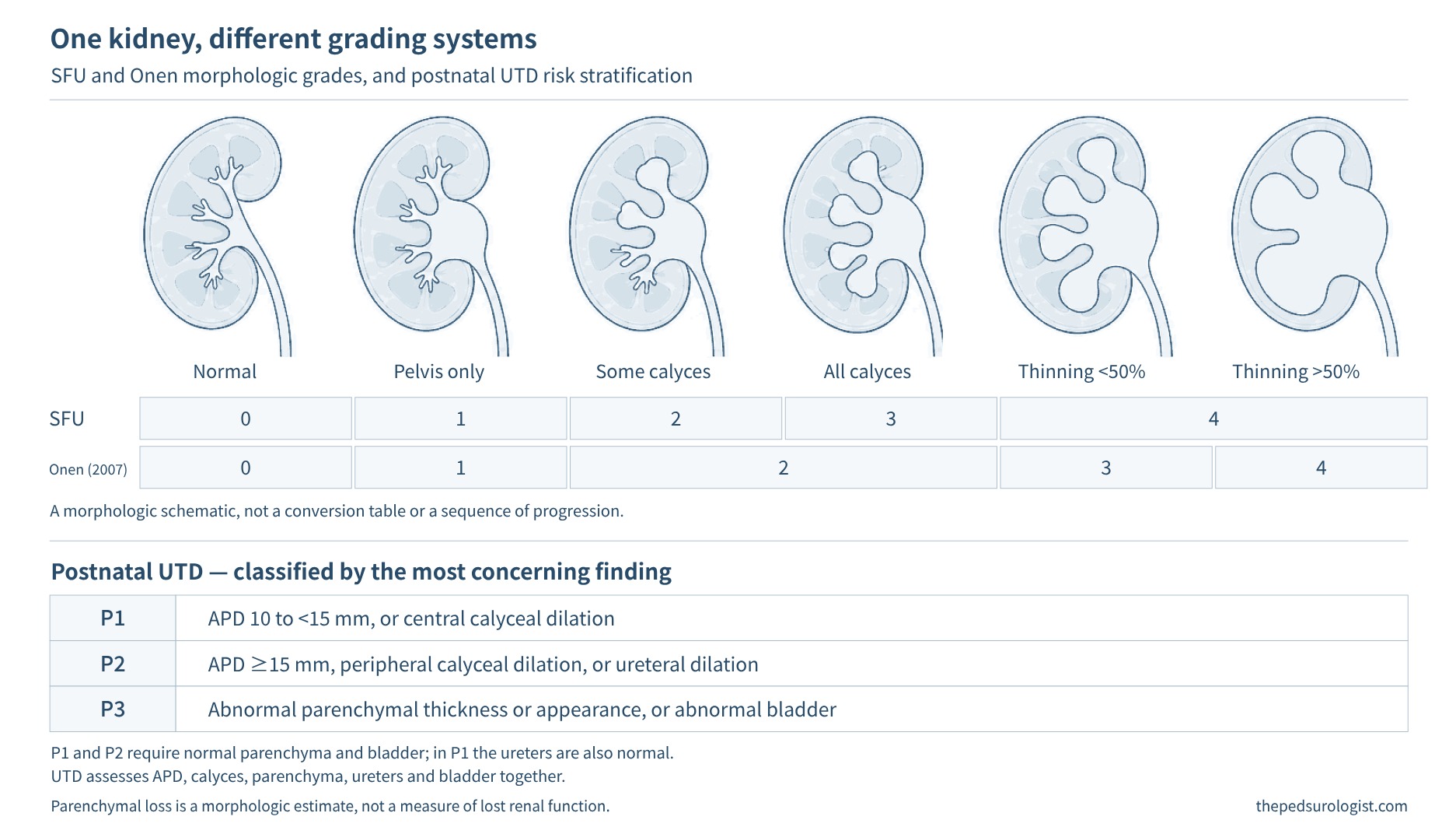 Six renal cross-sections (normal, pelvic dilation only, dilation of some calyces, dilation of all calyces, parenchymal loss under 50%, parenchymal loss over 50%) with SFU grades 0–4 and Onen grades 0–4 marked below, and a summary of the postnatal UTD P1–P3 criteria