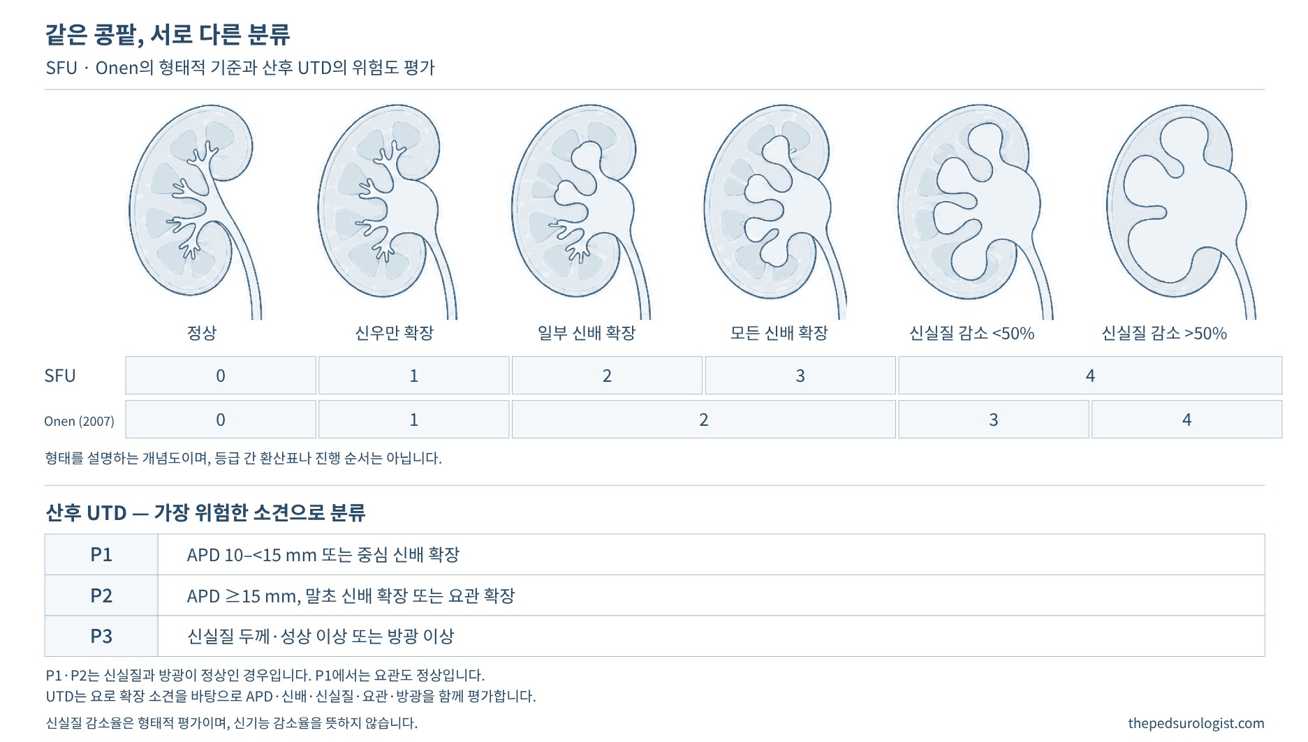 정상, 신우만 확장, 일부 신배 확장, 모든 신배 확장, 신실질 감소 50% 미만, 신실질 감소 50% 초과의 여섯 가지 콩팥 단면 아래에 SFU 0–4등급과 Onen 0–4등급을 표시하고, 산후 UTD P1–P3의 기준을 요약한 그림