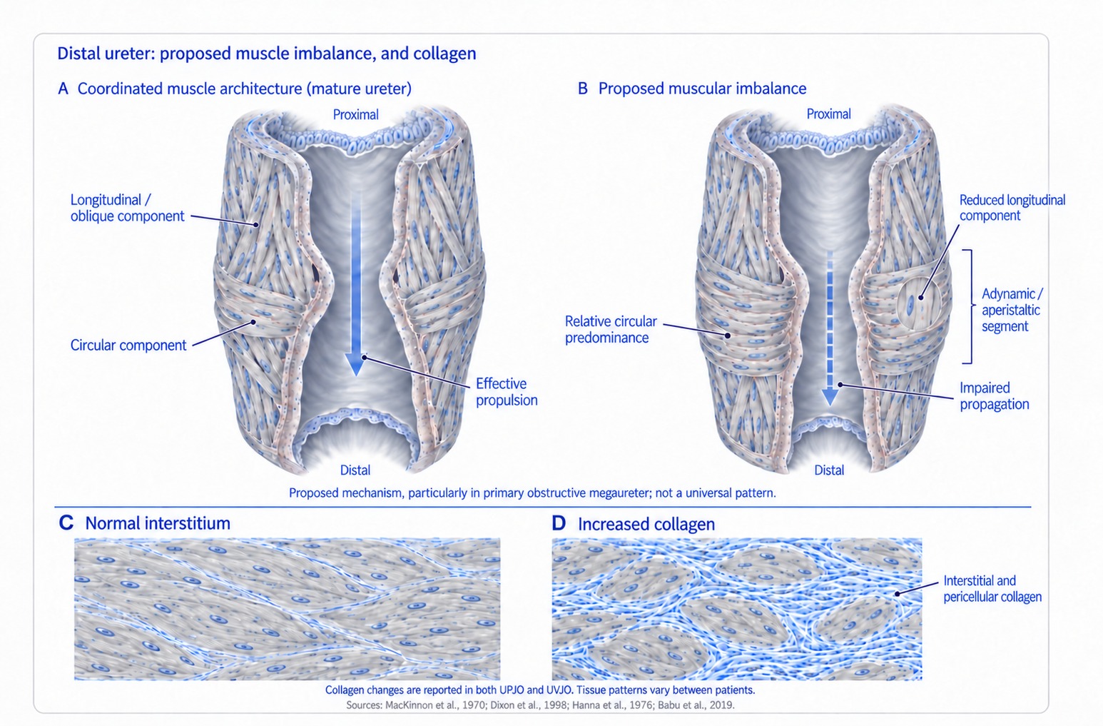 Illustration comparing muscle arrangement in the distal ureter. A shows the mature ureter, in which longitudinal and oblique components and circular components are arranged as a connected network so that peristalsis propagates efficiently; B shows the proposed mechanism in the adynamic segment, in which the longitudinal component is reduced and the circular component relatively dominant, impairing propagation of peristalsis; C and D compare normal interstitium with tissue showing increased collagen between muscle fascicles and around cells