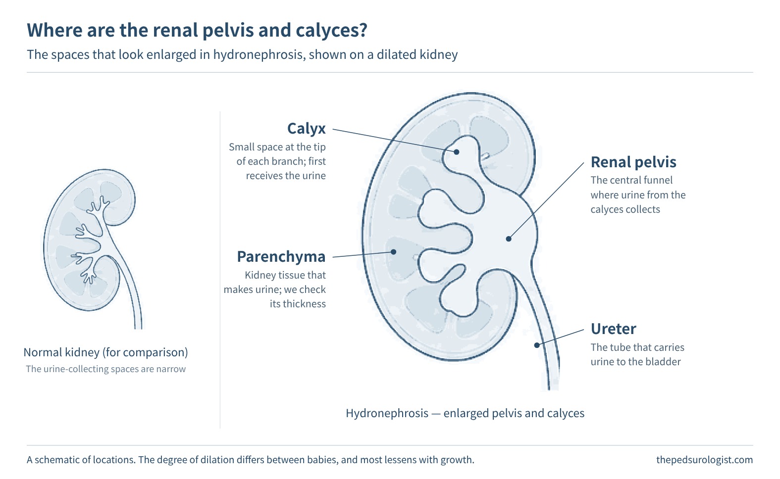 A normal kidney drawn side by side with a kidney whose renal pelvis and calyces are enlarged by hydronephrosis, with the calyces, renal pelvis, kidney tissue (parenchyma) and ureter labeled on the enlarged kidney