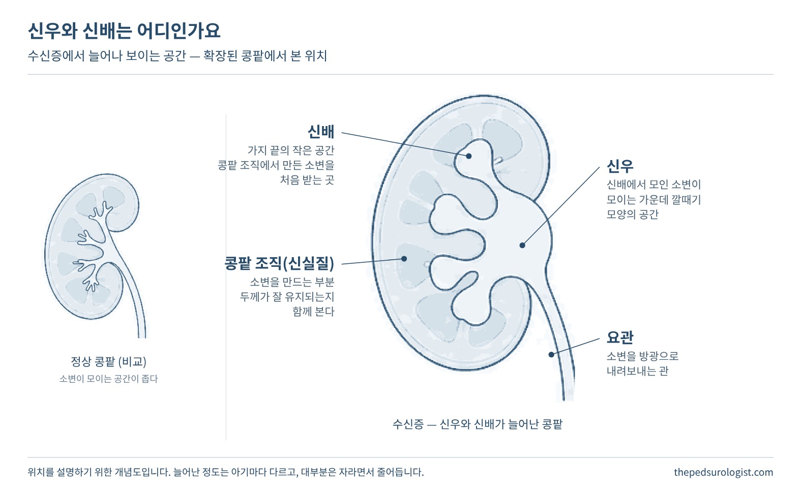 정상 콩팥과 수신증으로 신우와 신배가 늘어난 콩팥을 나란히 그리고, 늘어난 콩팥에 신배, 신우, 콩팥 조직(신실질), 요관의 위치를 표시한 그림