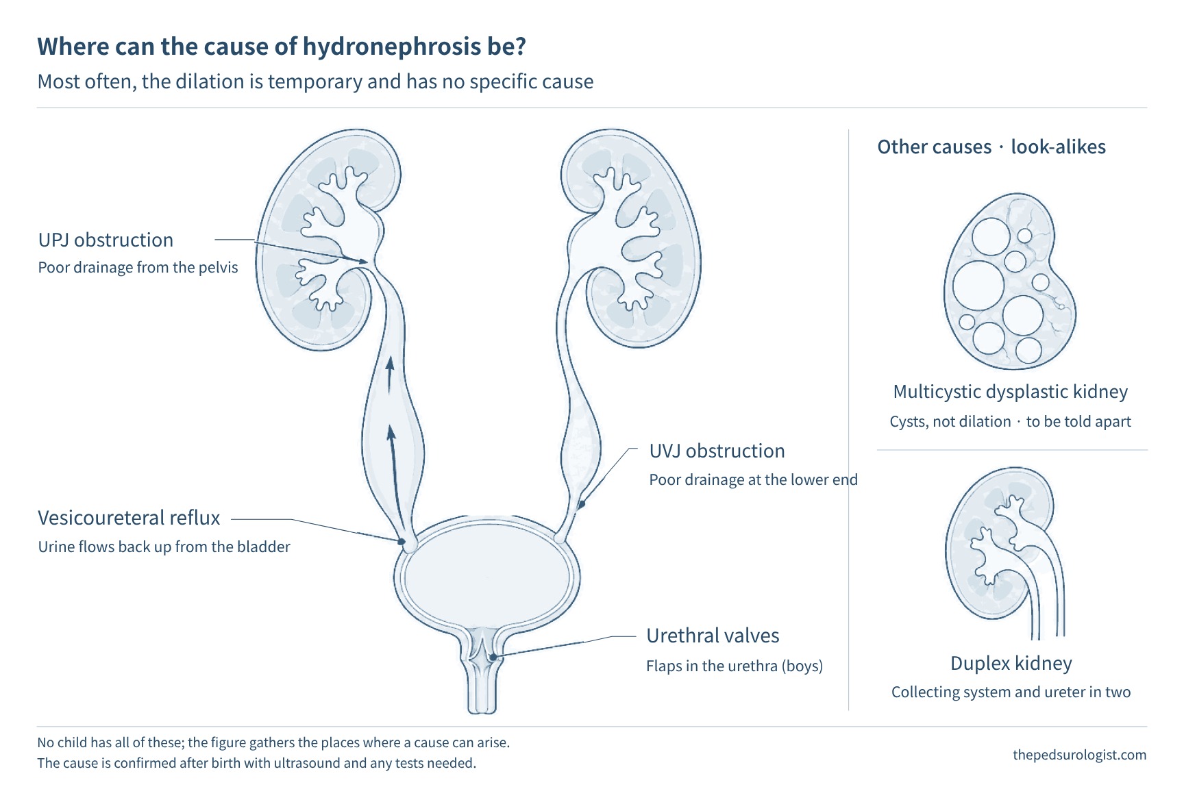 Drawing of both kidneys, the ureters, the bladder and the urethra, marking where the causes of hydronephrosis arise: ureteropelvic junction obstruction, vesicoureteral reflux, obstructive megaureter (urine not draining well at the lower end of the ureter), posterior urethral valves, multicystic dysplastic kidney, and duplex kidney