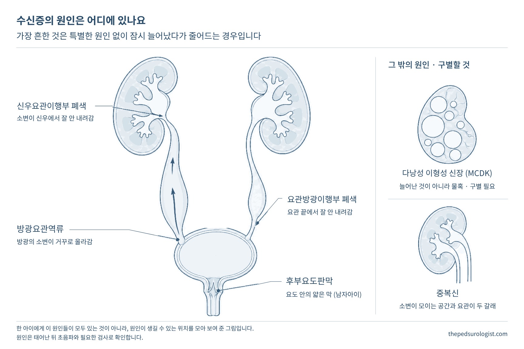 양쪽 콩팥, 요관, 방광, 요도를 그린 그림 위에 수신증의 원인이 생기는 위치를 표시한 그림. 신우요관이행부 폐색, 방광요관역류, 요관 아래쪽에서 소변이 잘 내려가지 않는 폐색성 거대요관, 후부요도판막, 다낭성 이형성 신장, 중복신