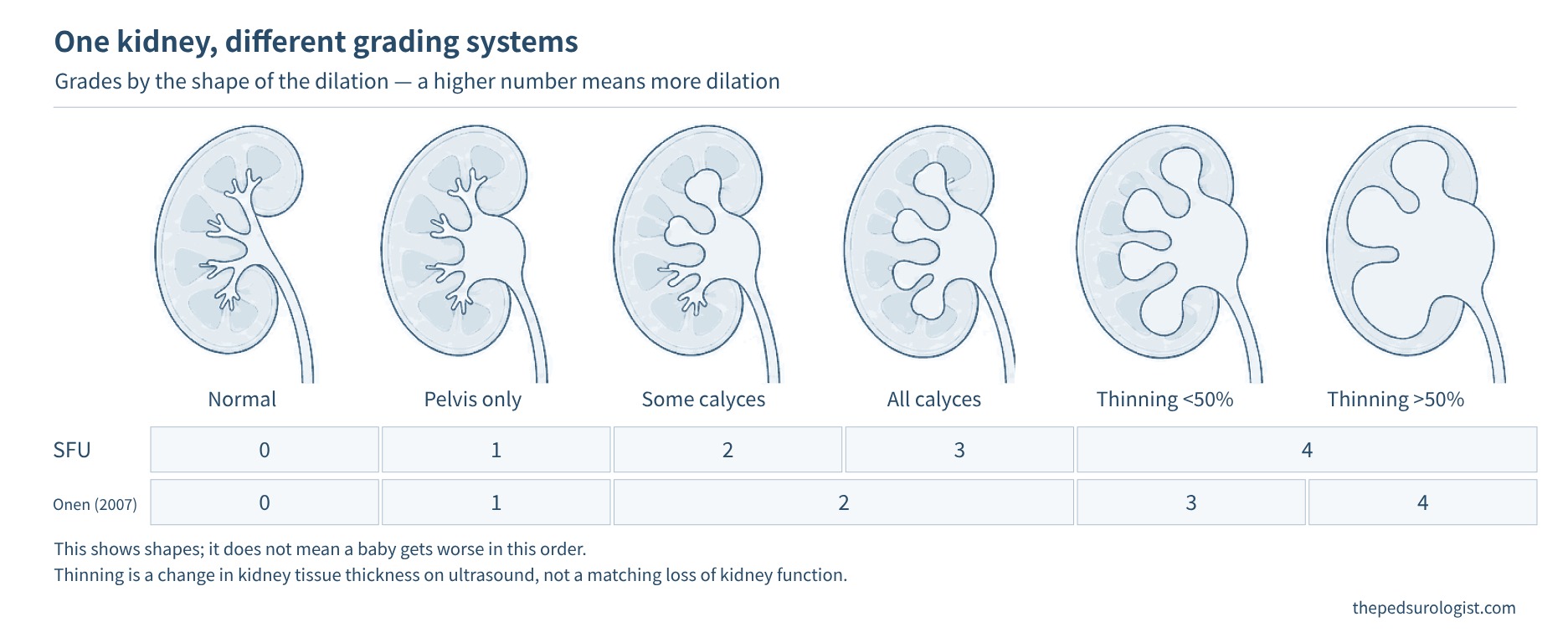 Six stages, from a normal kidney to a kidney with only the renal pelvis enlarged, kidneys with some or all of the calyces enlarged, and kidneys with thinned kidney tissue, with SFU grades 0–4 and Onen grades 0–4 shown below to indicate how they correspond