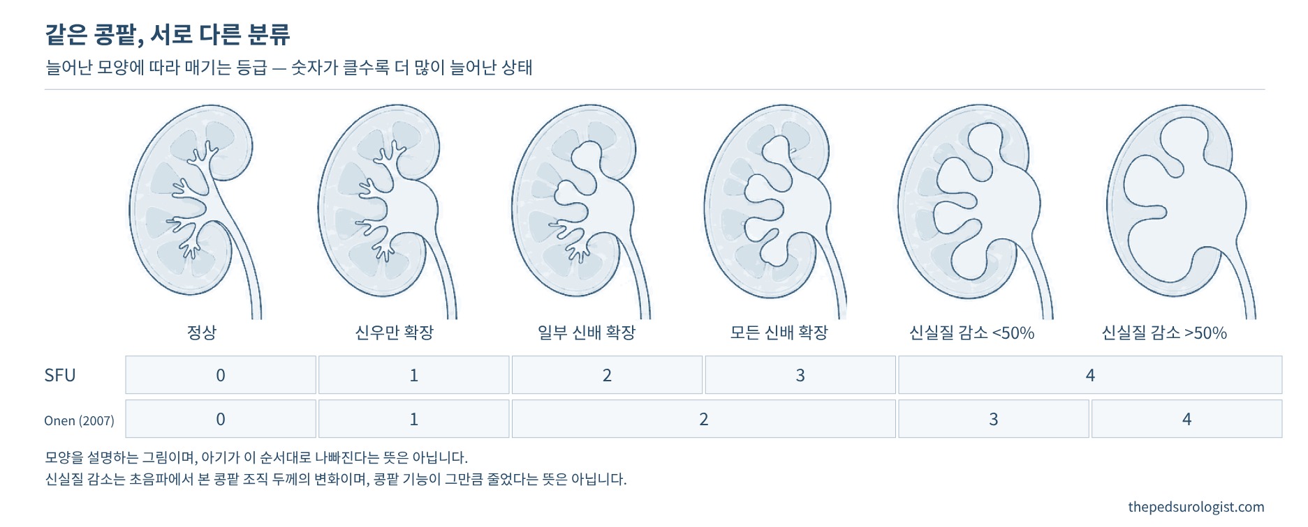 정상 콩팥부터 신우만 늘어난 콩팥, 일부 신배와 모든 신배가 늘어난 콩팥, 콩팥 조직이 얇아진 콩팥까지 여섯 단계를 그리고, 그 아래에 SFU 0~4등급과 Onen 0~4등급이 어떻게 대응하는지 표시한 그림