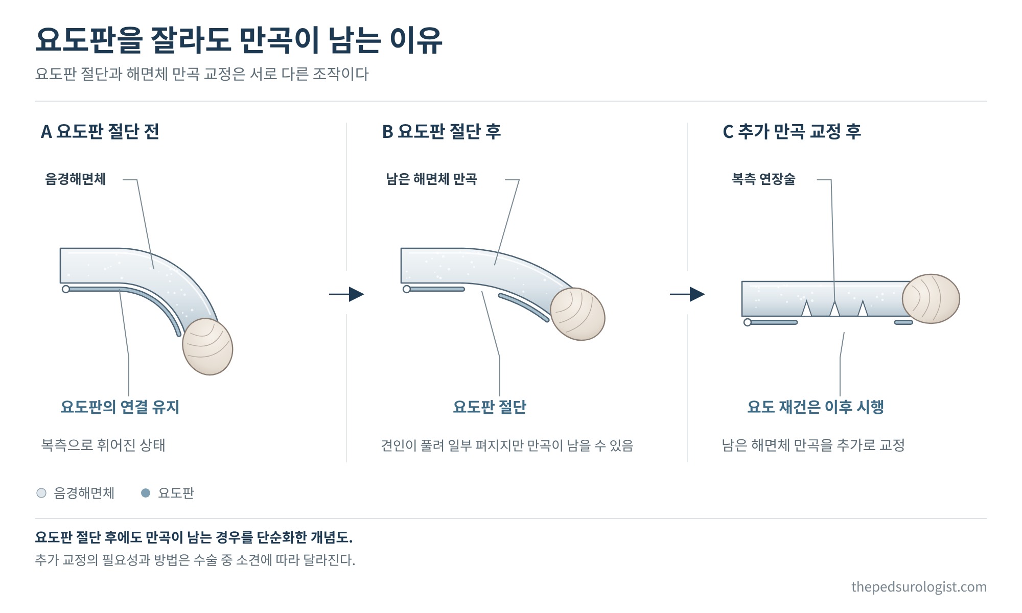 요도판 절단 전 복측으로 휜 음경, 요도판을 절단한 뒤에도 남는 해면체 만곡, 복측 연장술로 추가 교정한 뒤 곧게 펴진 음경을 옆에서 본 세 단계 개념도