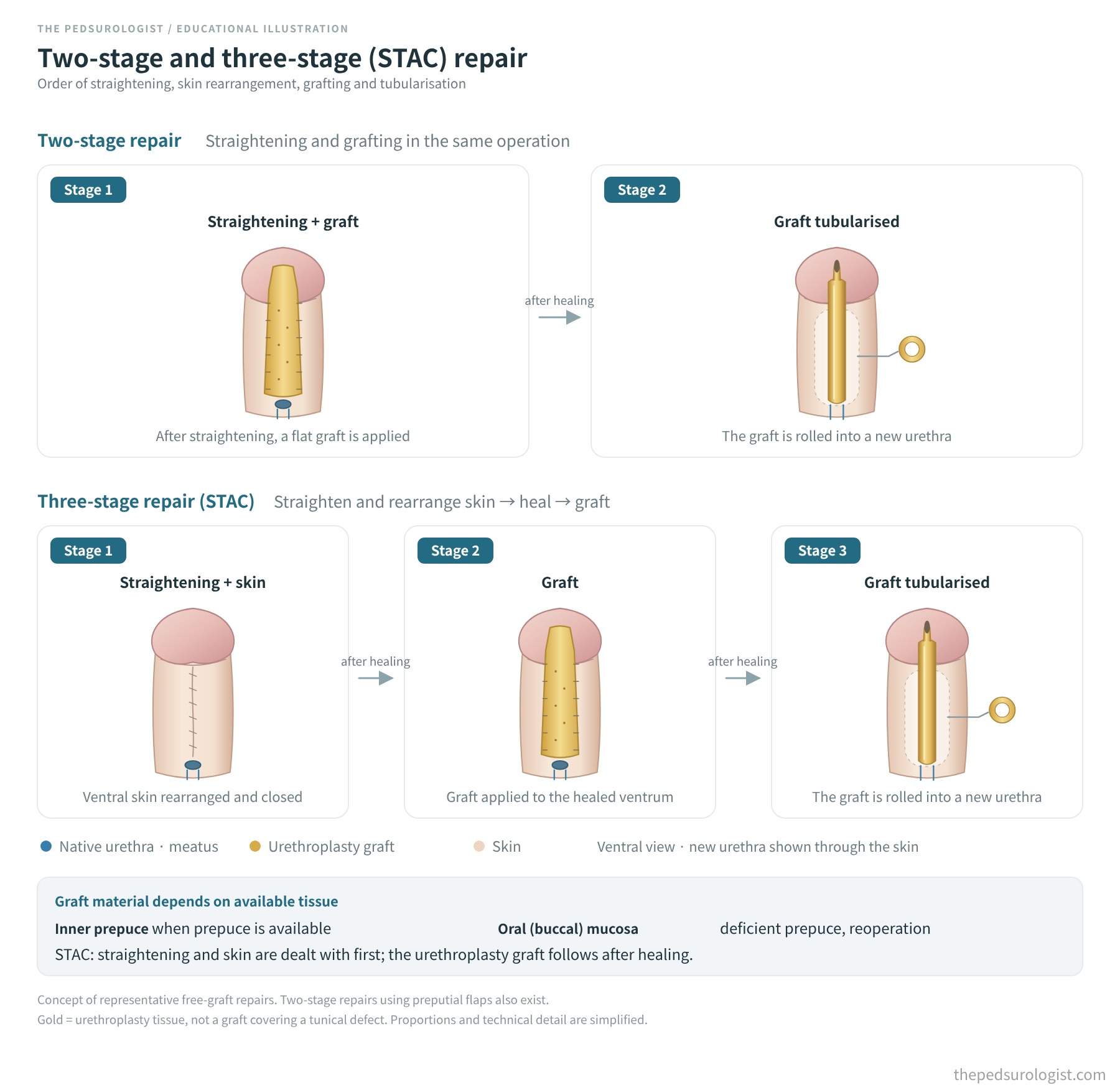 Ventral views comparing two-stage repair (straightening and graft, then tubularisation) with three-stage repair (straightening and skin, then graft, then tubularisation)