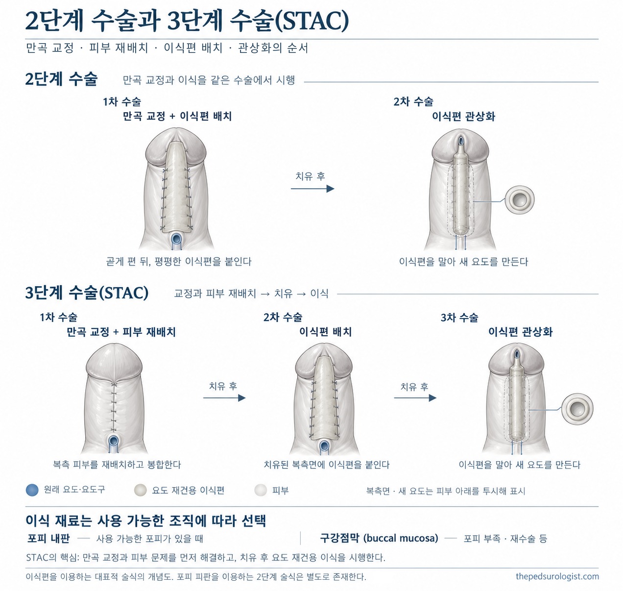 2단계 수술은 1차에 만곡 교정과 요도 재건용 이식편 배치, 2차에 관상화를 하고, 3단계 수술은 1차 만곡 교정과 피부 재배치, 2차 이식편 배치, 3차 관상화로 나누는 순서를 복측에서 본 도식