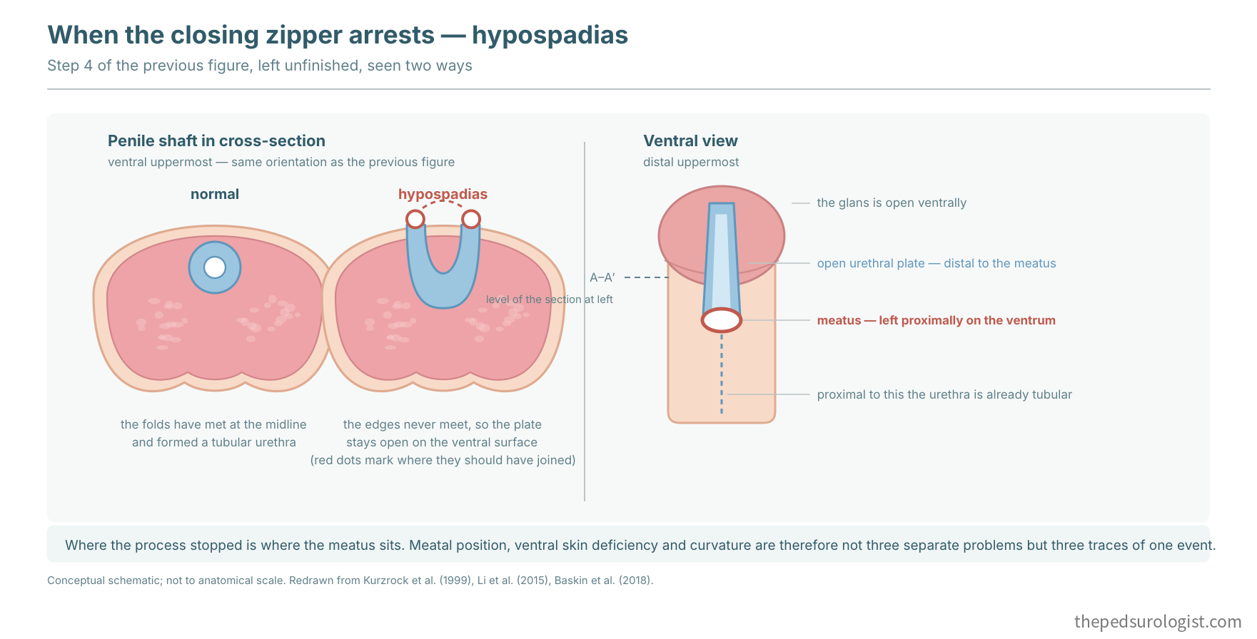 Hypospadias from an incomplete closing zipper, shown in cross-section of the penile shaft against the normal tubular urethra, and in ventral view with an open urethral plate and a proximally placed meatus
