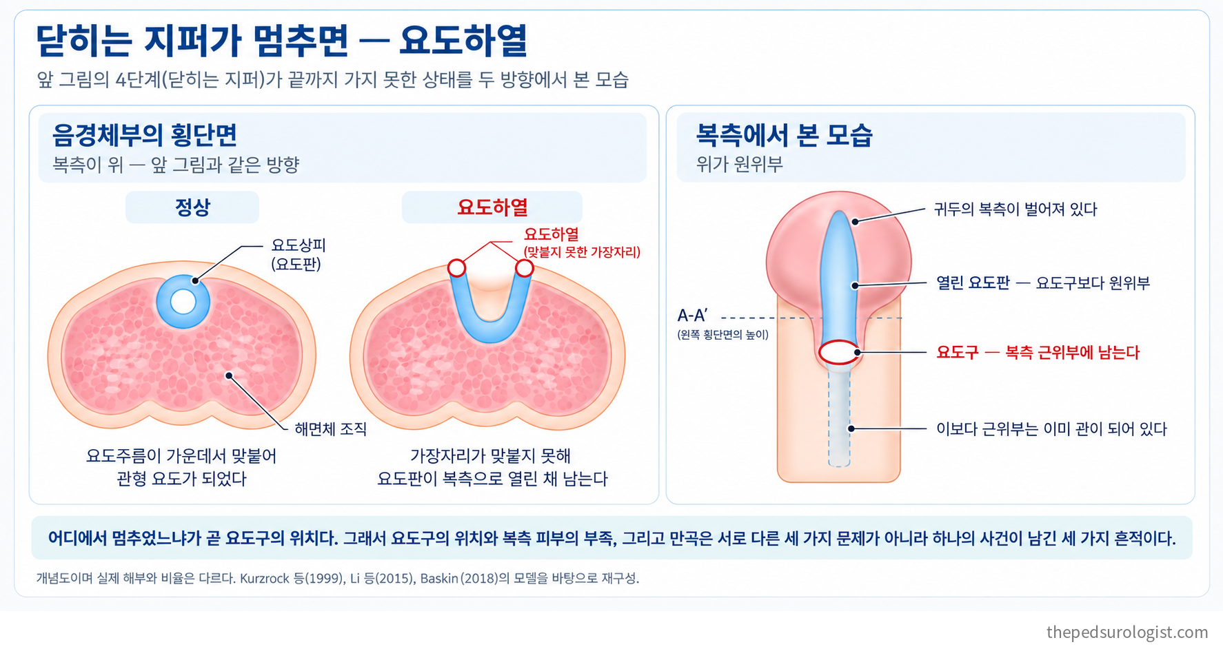 닫히는 지퍼가 완결되지 못한 요도하열 — 왼쪽은 음경체부 횡단면으로 정상의 관형 요도와 맞붙지 못해 복측으로 열린 요도판을 비교하고, 오른쪽은 복측에서 본 모습으로 벌어진 귀두, 열린 요도판, 근위부에 남은 요도구를 보여준다