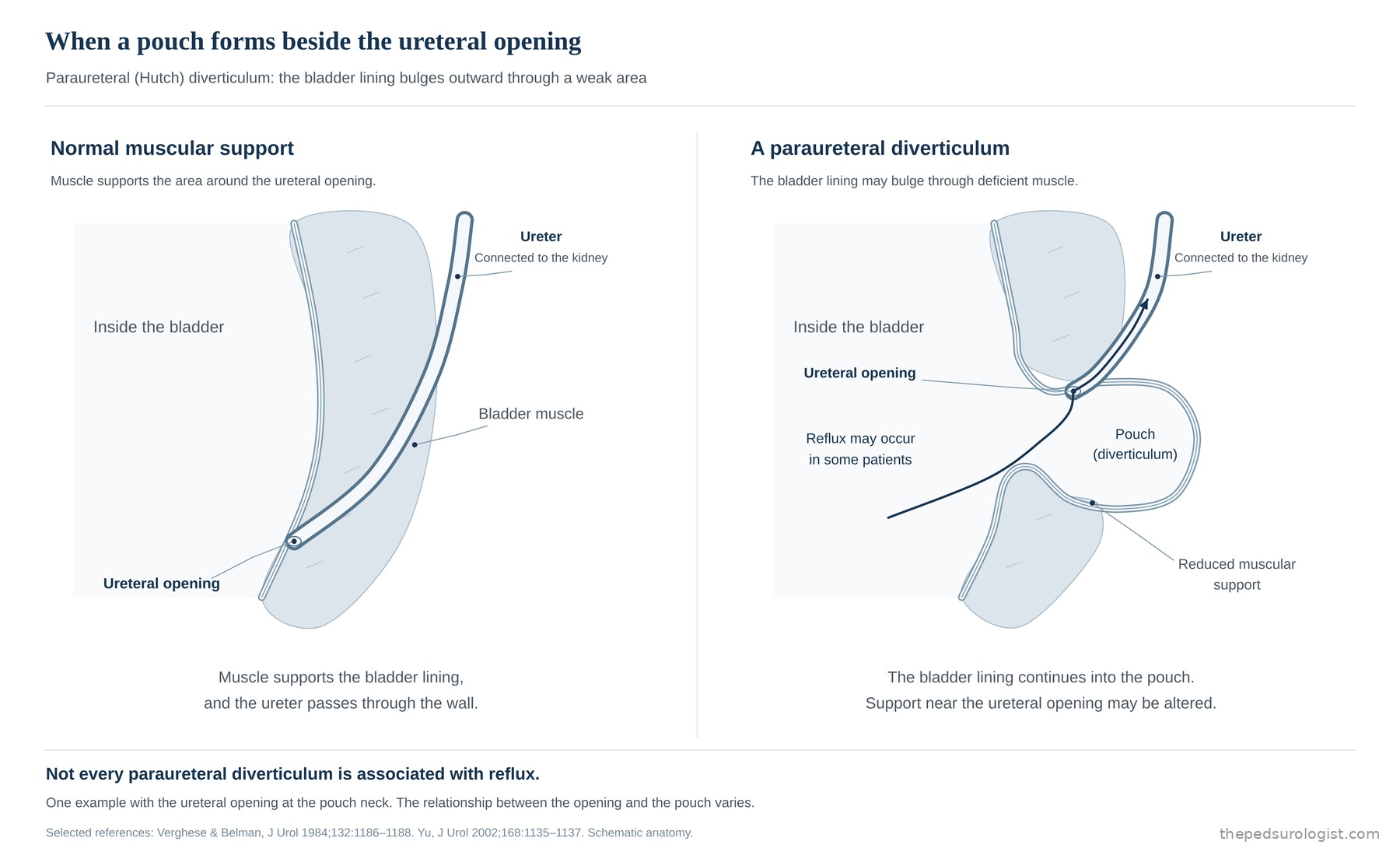 Comparison of normal muscular support and a paraureteral diverticulum. On the left, the bladder-wall muscle supports the area around the ureteral opening and the ureter passes through the wall into the bladder. On the right, the bladder lining bulges as a pouch through an area of deficient muscle, with the ureteral opening at its neck, and reflux may occur in some patients