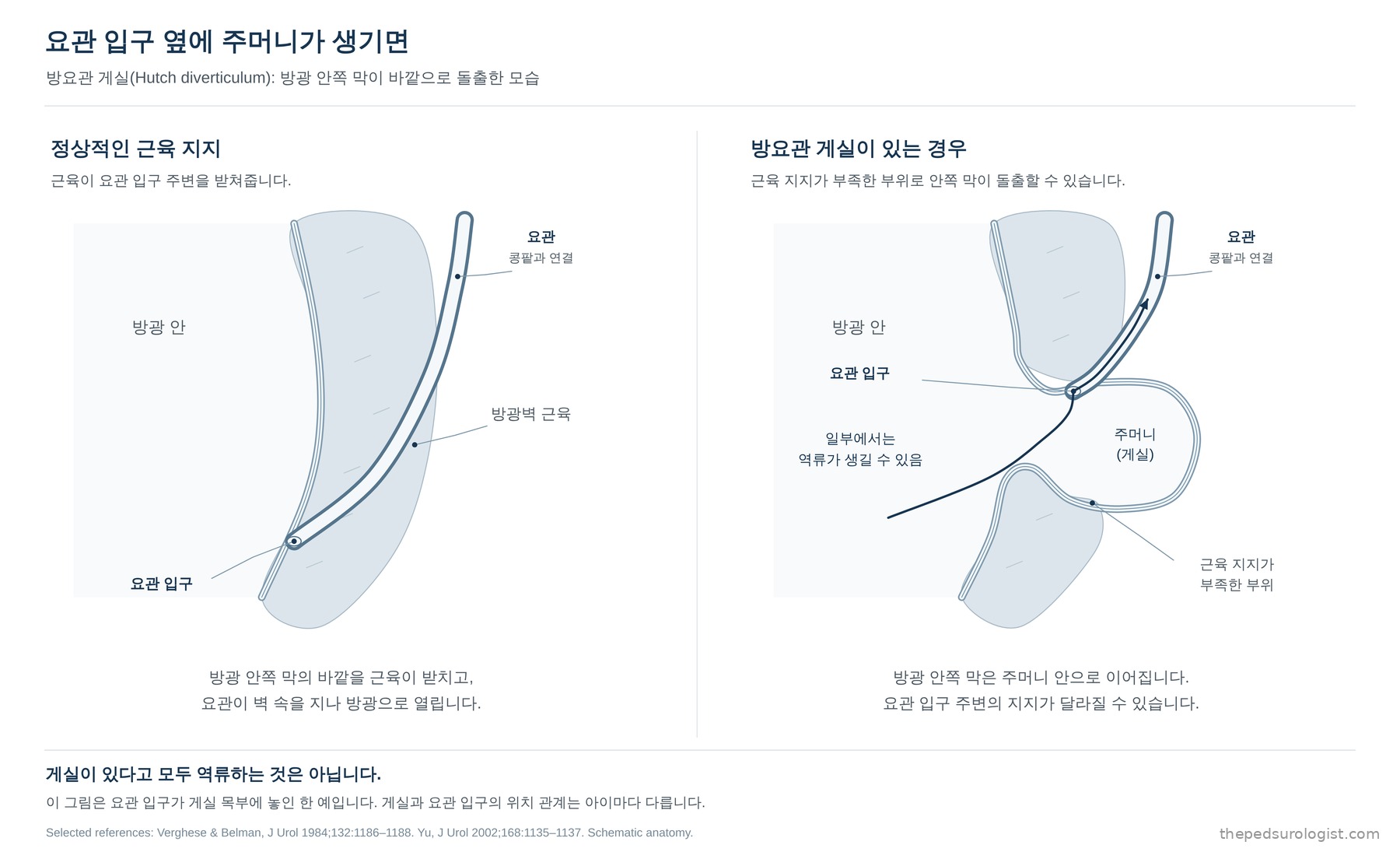 정상적인 근육 지지와 방요관 게실을 비교한 그림. 왼쪽은 방광벽 근육이 요관 입구 주변을 받치고 요관이 벽 속을 지나 방광으로 열리는 모습이고, 오른쪽은 근육 지지가 부족한 부위로 방광 안쪽 막이 주머니처럼 돌출하고 요관 입구가 그 목부에 놓여 일부에서 역류가 생길 수 있는 모습이다