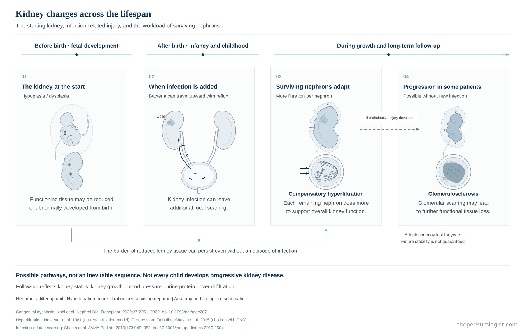 Illustration of kidney changes in four stages from before birth through growth. 1 shows a kidney formed smaller or differently from the start; 2 shows bacteria travelling up with reflux and leaving a scar in part of the kidney; 3 shows remaining nephrons filtering more to support overall function; 4 shows, in some patients where the load builds up, glomeruli scarring and further loss of working tissue. It also marks that the load of reduced tissue can continue even without infection