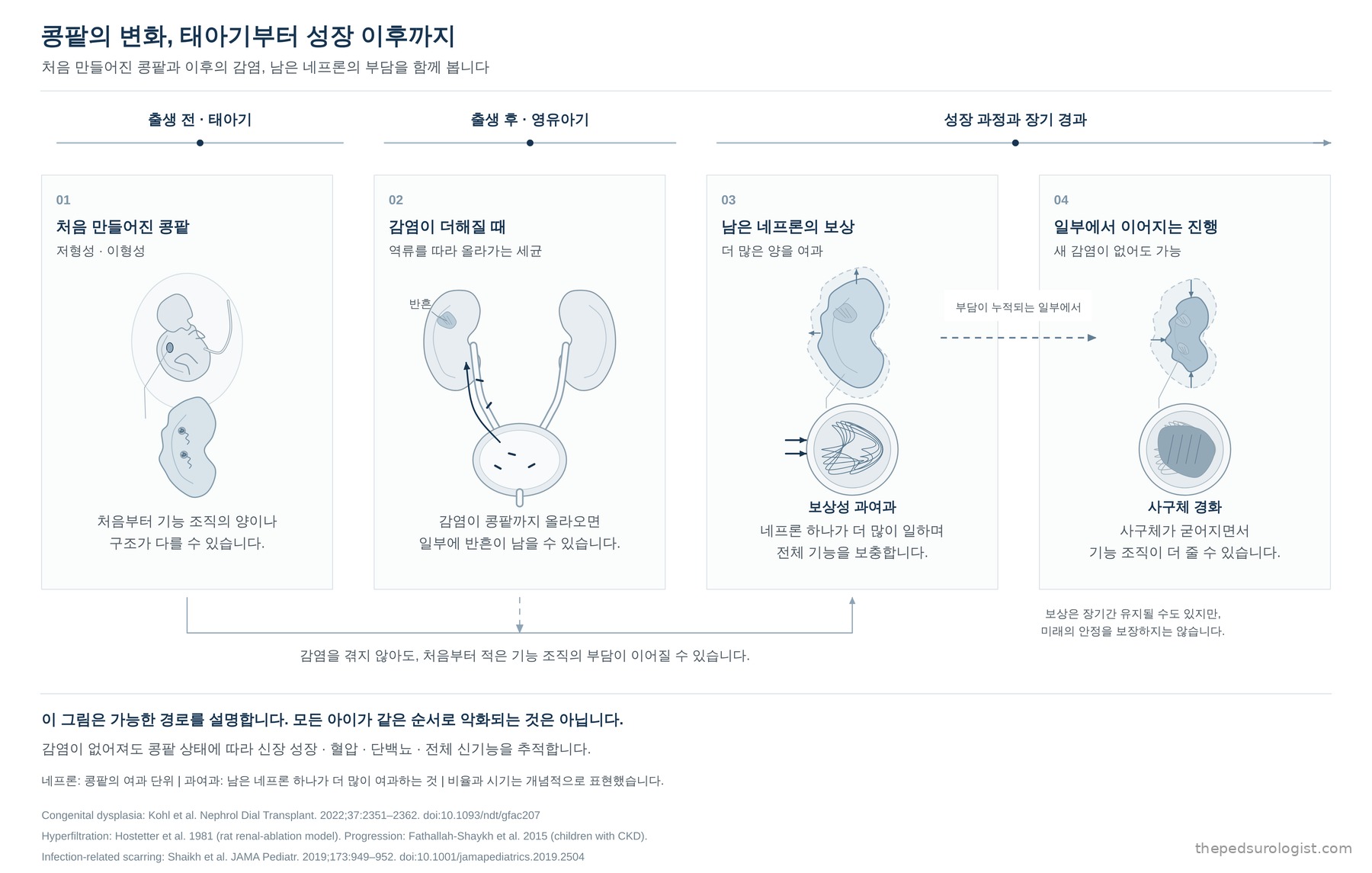 태아기부터 성장 이후까지 콩팥의 변화를 네 단계로 보여주는 그림. 1은 처음부터 작거나 다르게 만들어진 콩팥, 2는 역류를 따라 올라간 세균으로 콩팥 일부에 반흔이 남는 모습, 3은 남은 네프론이 더 많이 여과하며 전체 기능을 보충하는 보상, 4는 부담이 누적되는 일부에서 사구체가 굳어지며 기능 조직이 더 줄어드는 진행이다. 감염이 없어도 처음부터 적은 기능 조직의 부담이 이어질 수 있음을 함께 표시했다