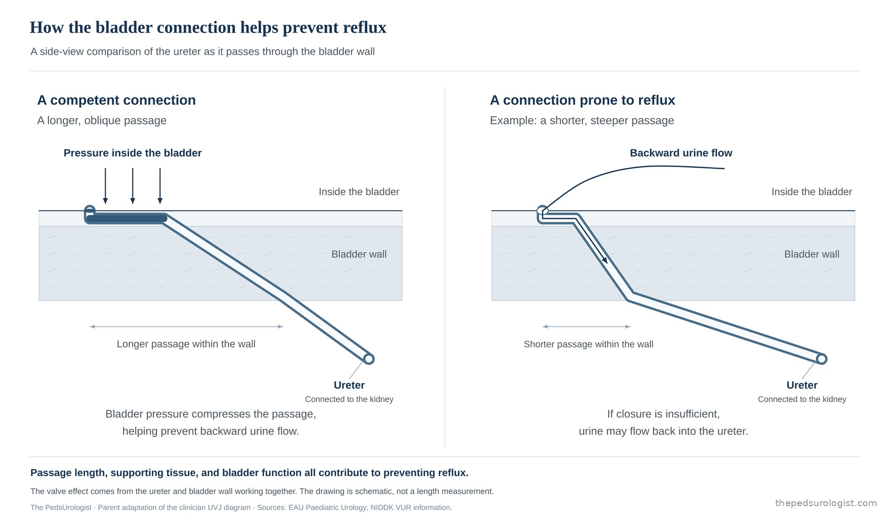 Side-view comparison of the ureter passing through the bladder wall. On the left, in a competent connection, the ureter runs a long, oblique course within the wall so that bladder pressure compresses the passage and prevents backward flow. On the right, in a connection prone to reflux, the passage is short and steep, does not close fully, and urine may flow back into the ureter