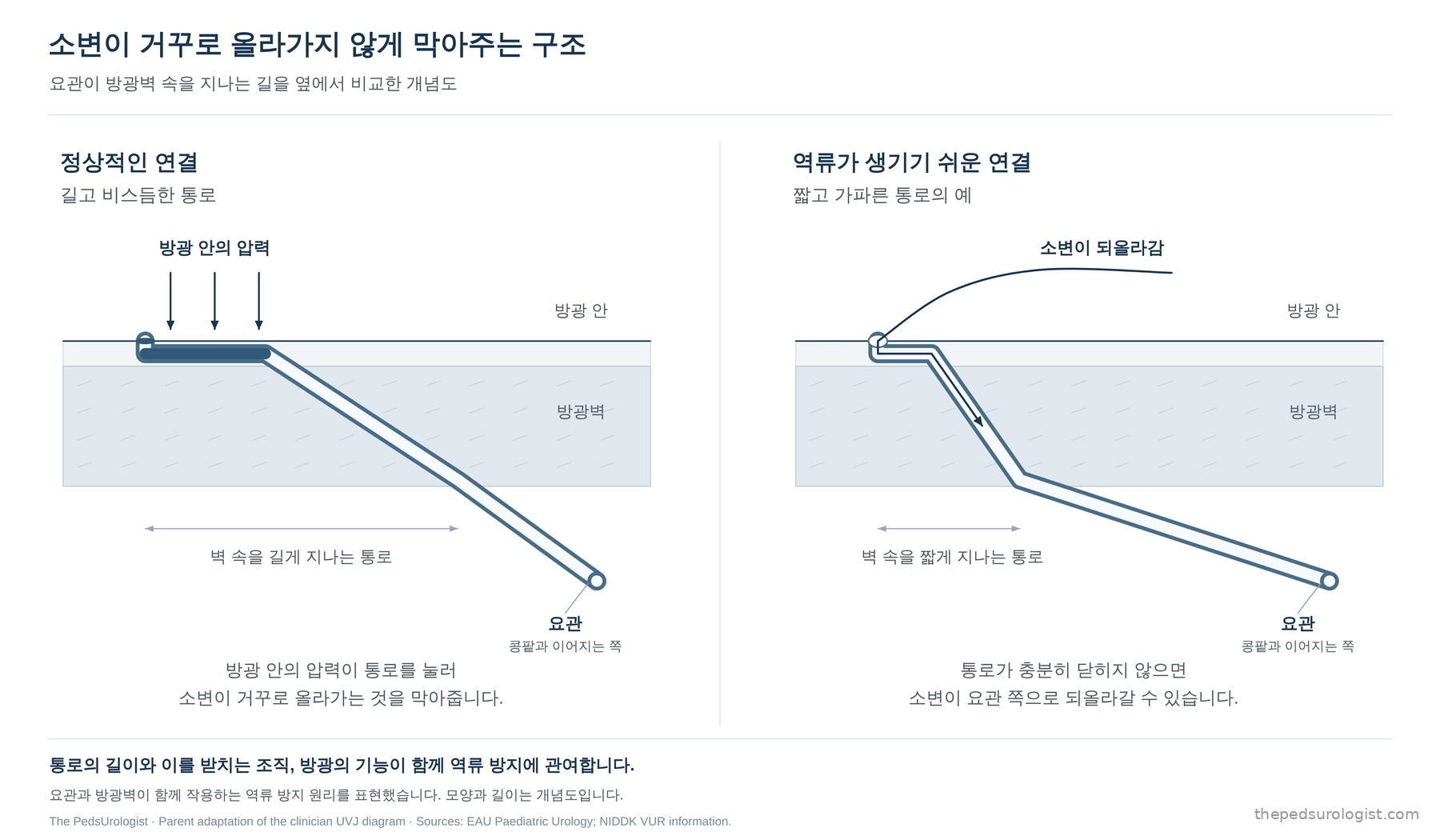 요관이 방광벽 속을 지나는 길을 옆에서 비교한 그림. 왼쪽 정상적인 연결에서는 요관이 벽 속을 길고 비스듬하게 지나 방광 안의 압력이 통로를 눌러 소변이 거꾸로 올라가는 것을 막는다. 오른쪽 역류가 생기기 쉬운 연결에서는 벽 속을 짧고 가파르게 지나 통로가 충분히 닫히지 않아 소변이 요관 쪽으로 되올라갈 수 있다