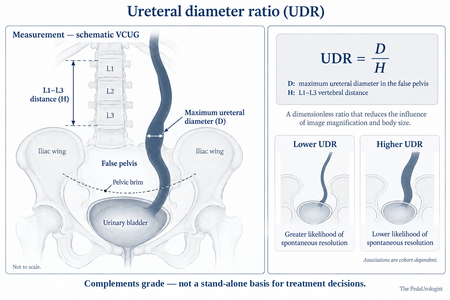 Schematic showing how the ureteral diameter ratio is measured. On the left, a simplified voiding cystourethrogram marks the maximum ureteral diameter D within the false pelvis and the L1 to L3 vertebral distance H. On the right, UDR is defined as D divided by H, described as a dimensionless ratio that reduces the influence of image magnification and body size, with lower UDR indicating greater likelihood of spontaneous resolution and higher UDR less