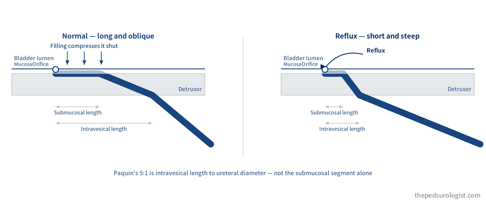 Longitudinal section of the ureterovesical junction comparing normal and refluxing anatomy. In the normal panel the ureter pierces the detrusor obliquely and runs a long course beneath the mucosa before opening at the orifice, and bladder filling compresses it shut. In the refluxing panel the same course is short and steep, with both intravesical and submucosal length falling short, and urine passes retrogradely. Intravesical length and submucosal length are marked separately